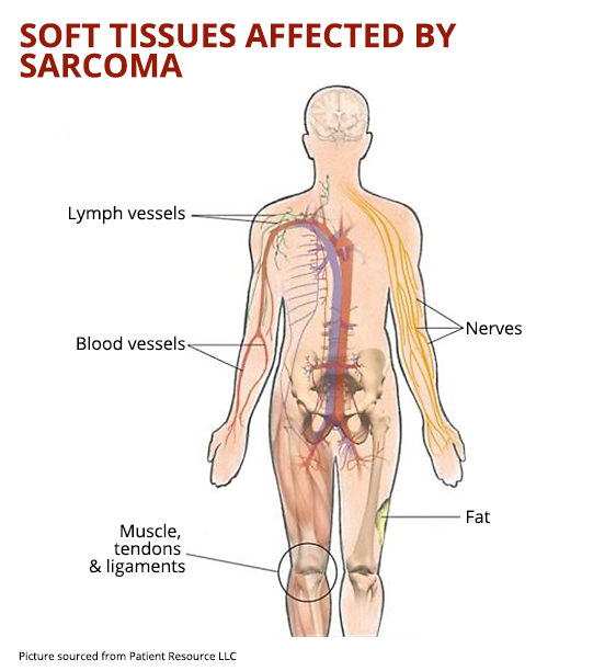 sarcoma cancer of connective tissue